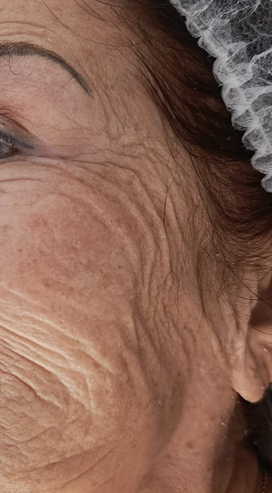 לפני הטיפול